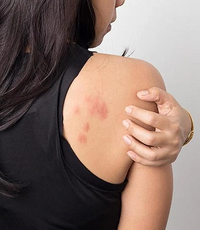Homeopathic Skin Disease Treatment for Psoriasis and Acne by Dr Pragi Patel Ahmedabad